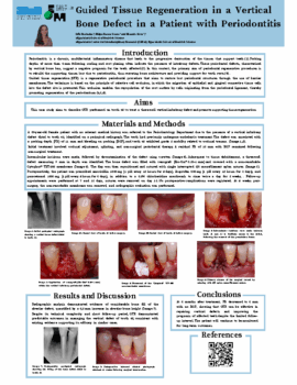 Poster-Guided-Tissue-Regeneration-in-a-Vertical-Bone-Defect-in-a-7a6cc9da91ab7a003aae33bf442eb224